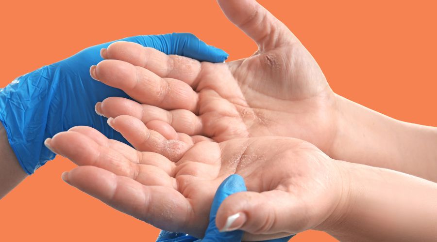 Understanding Contact Dermatitis: Symptoms, Causes, and Treatment
