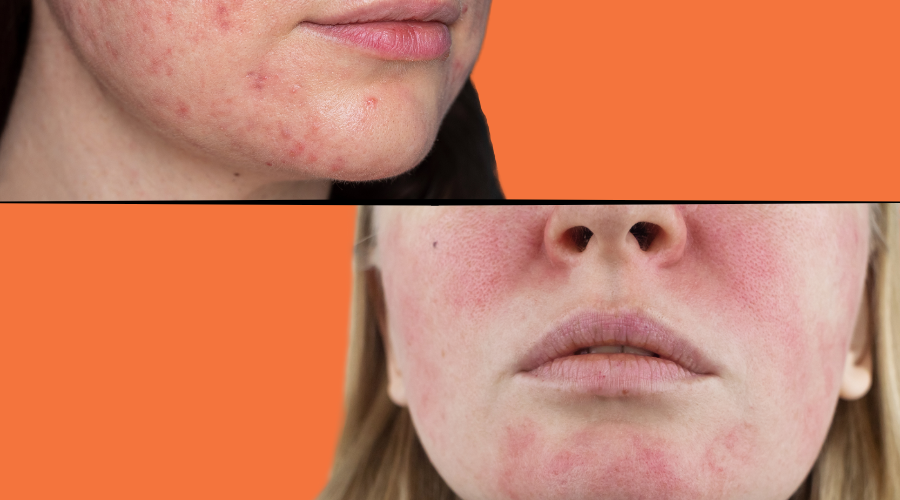 Rosacea remedies