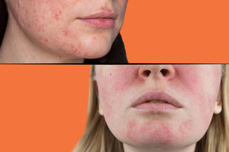 Rosacea remedies