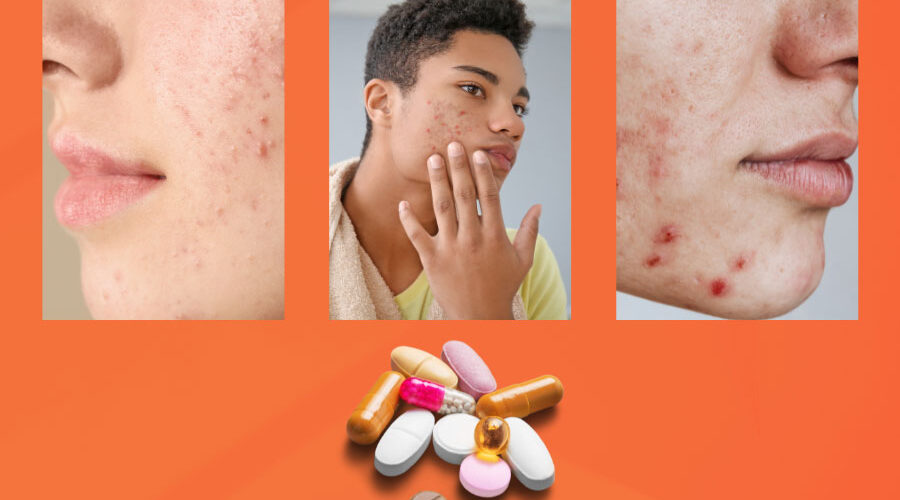 Your isotretinoin acne treatment journey: A step-by-step guide