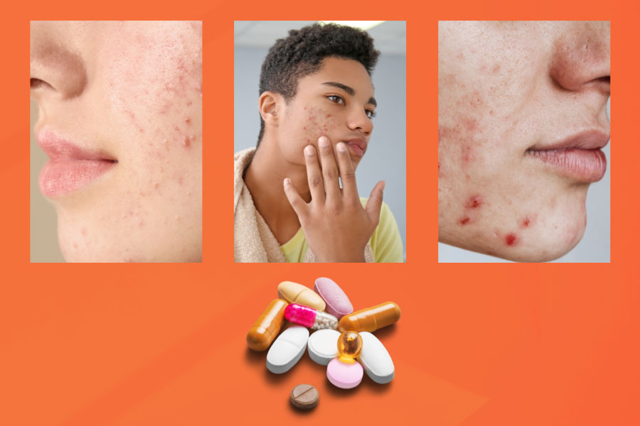 Your isotretinoin acne treatment journey: A step-by-step guide