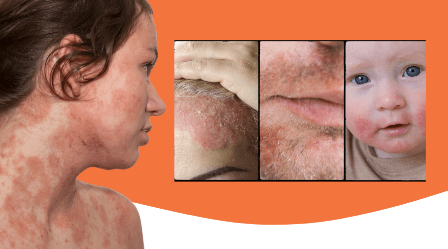 The ABCs of seborrhoeic dermatitis Symptoms, causes, and treatment strategies - Dermo Direct