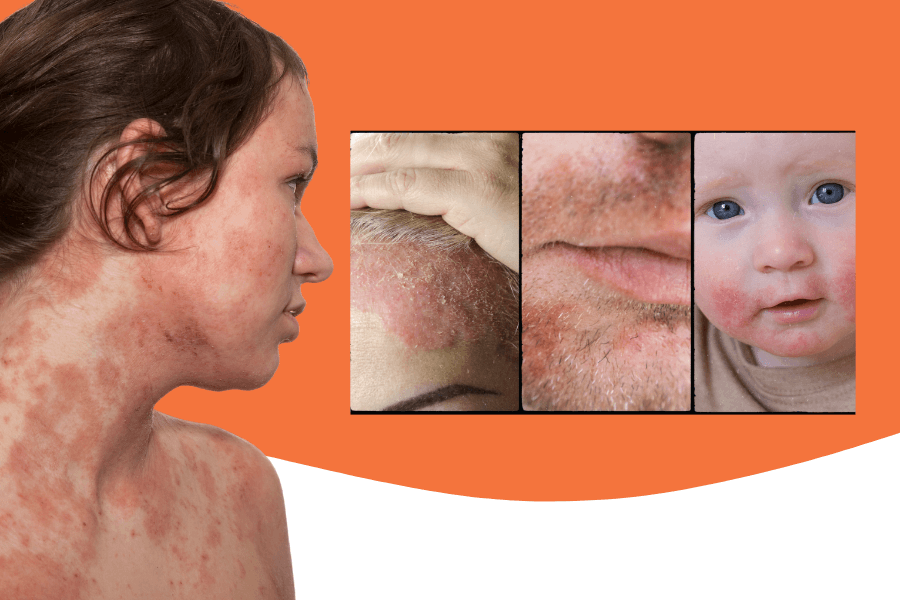 The ABCs of seborrhoeic dermatitis Symptoms, causes, and treatment strategies - Dermo Direct