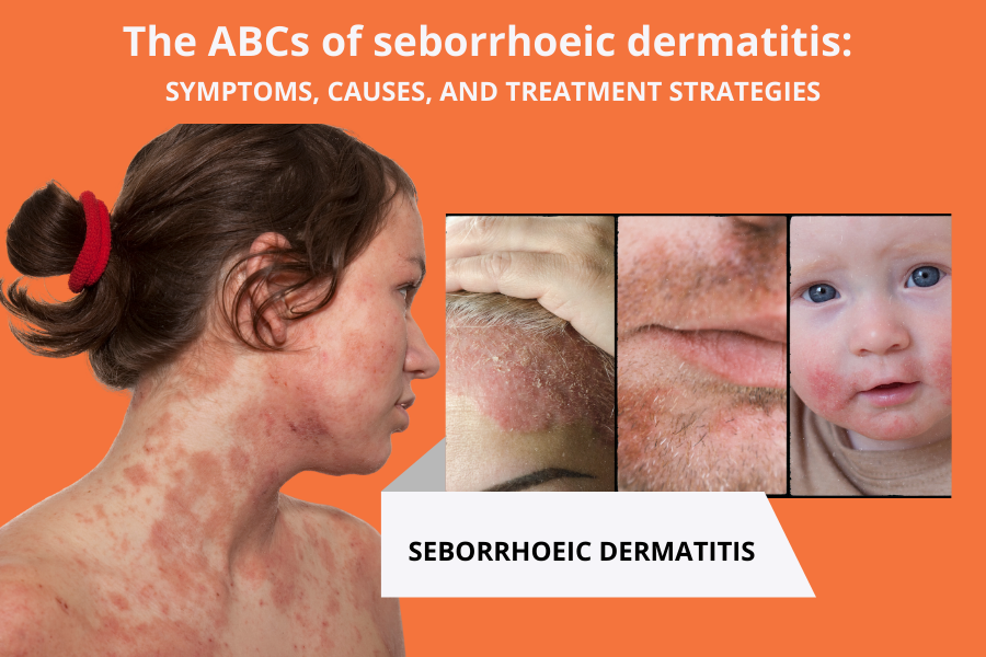 The ABCs of seborrhoeic dermatitis: Symptoms, causes, and treatment strategies