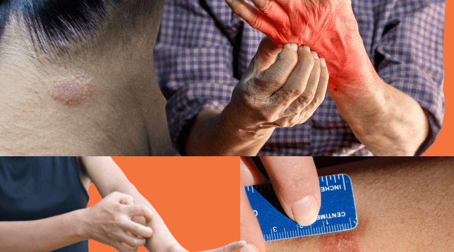 How to treat and prevent tinea: a complete guide to battling fungal infections