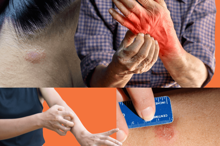 How to treat and prevent tinea: a complete guide to battling fungal infections