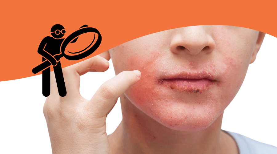 Perioral dermatitis: Identifying and managing this persistent skin condition