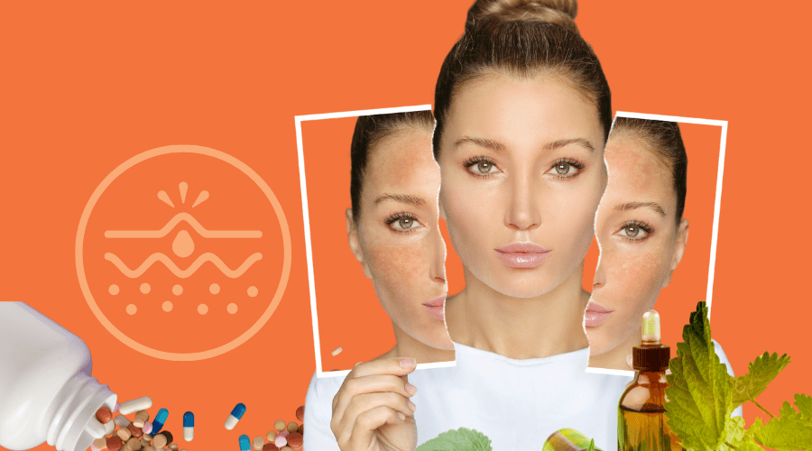 Acne, eczema, and psoriasis: understanding the most common skin conditions and how to treat them