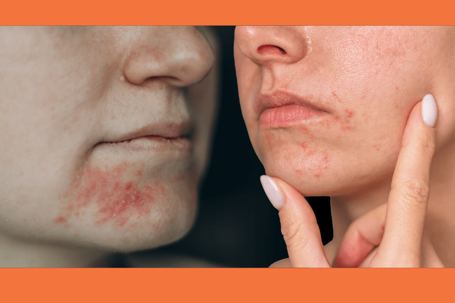 Perioral Dermatitis: Identifying and managing this persistent skin condition