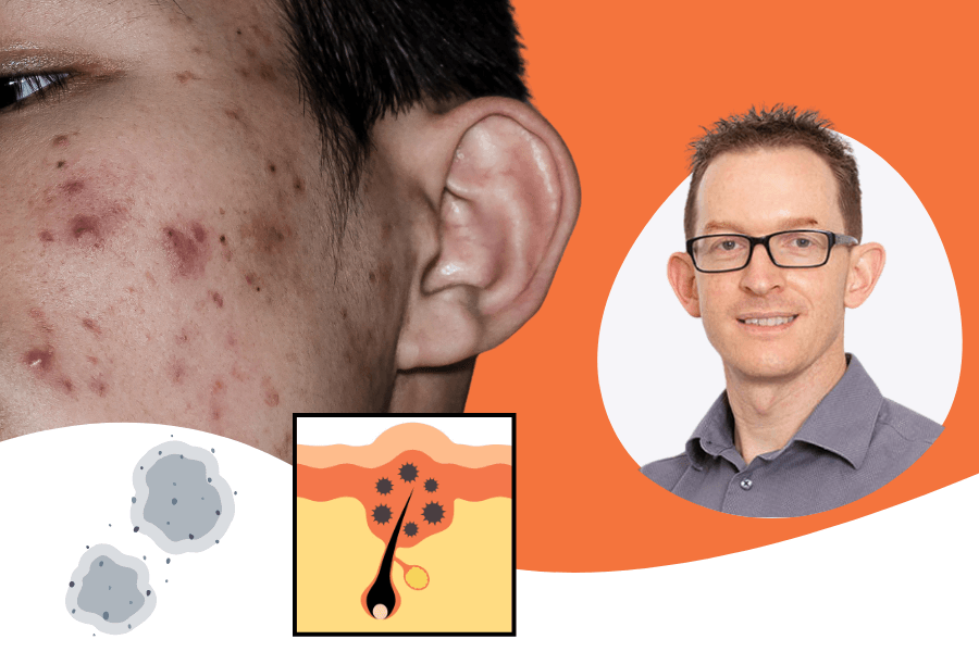 “Fungal Acne” — Why the Term Causes So Much Confusion (And What’s Really Going On)