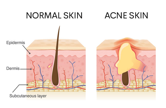 normal skin vs acne skin