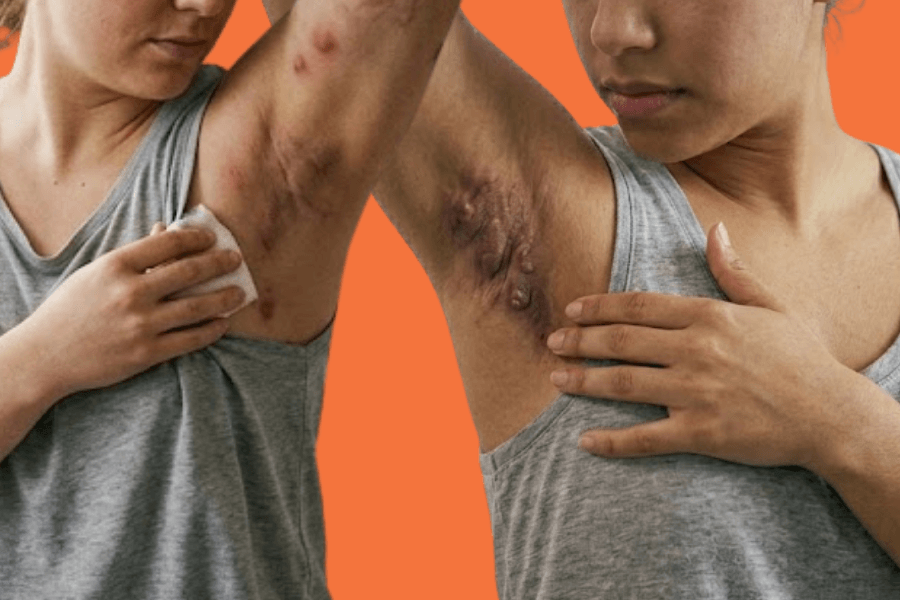 Hidradenitis Suppurativa