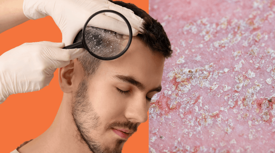 Seborrhoeic Dermatitis: What It Is, Why It Happens, and How to Manage It