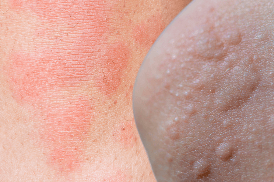 Urticaria (Hives)