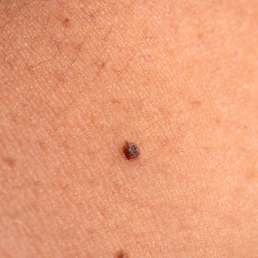 close up mole