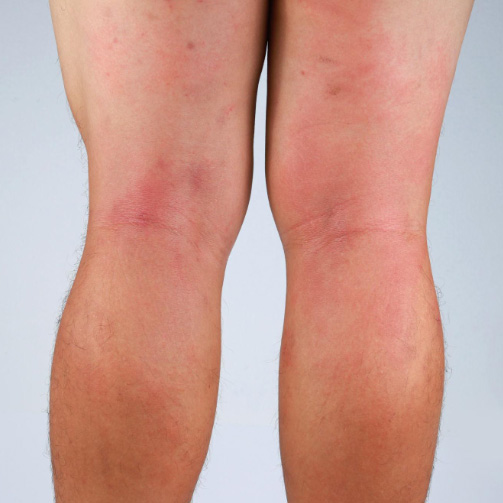 skin condition on legs